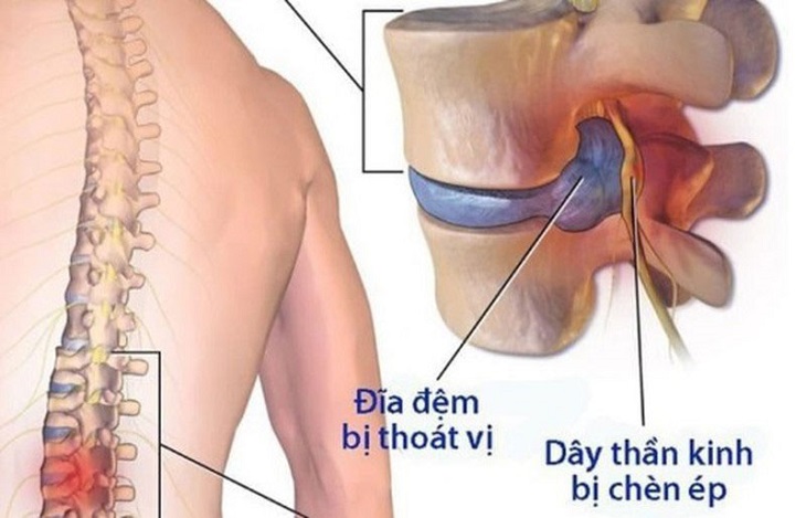 Thoát vị đĩa đệm là một trong những nguyên nhân đẫn đến bệnh