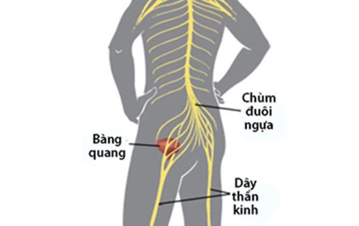 Hội chứng chùm đuôi ngựa