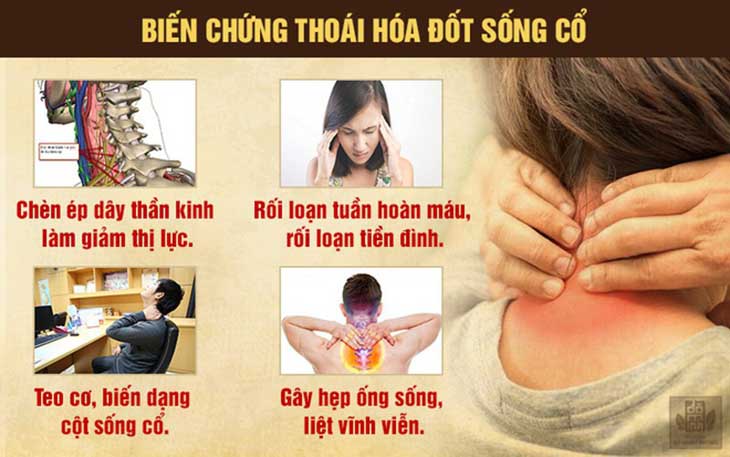 Thoái hóa cột sống cổ nếu để lâu sẽ gây ảnh hưởng lớn đến một số bộ phận chức năng trong cơ thể