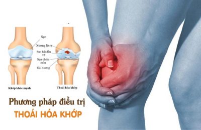 phương pháp điều trị thoái hóa khớp