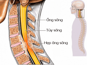 Hình ảnh hẹp ống sống cổ