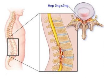 Hẹp ống sống thắt lưng là bệnh lý dễ gặp ngày nay