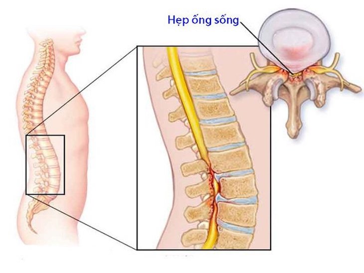 Hẹp ống sống thắt lưng là bệnh lý dễ gặp ngày nay