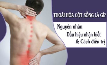 Thoái hóa cột sống là tình trạng sụn khớp cùng đĩa đệm bị bào mòn, tổn thương