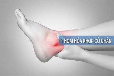 Thoái hóa khớp cổ chân là tình trạng loạn dưỡng của khớp