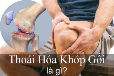 Thoái hóa khớp gối là tình trạng mô sụn bị bào mòn, hư hại, xơ hóa và giảm khả năng đàn hồi