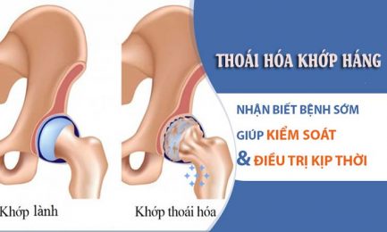 Thoái hóa khớp háng là tình trạng sụn khớp và xương dưới sụn vùng háng bị bào mòn