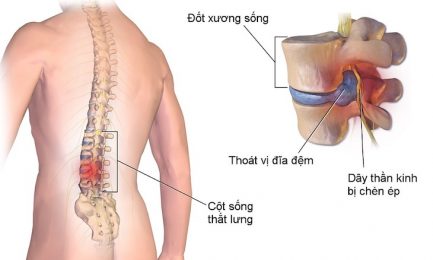 Tìm hiểu chứng thoát vị đĩa đệm chèn dây thần kinh