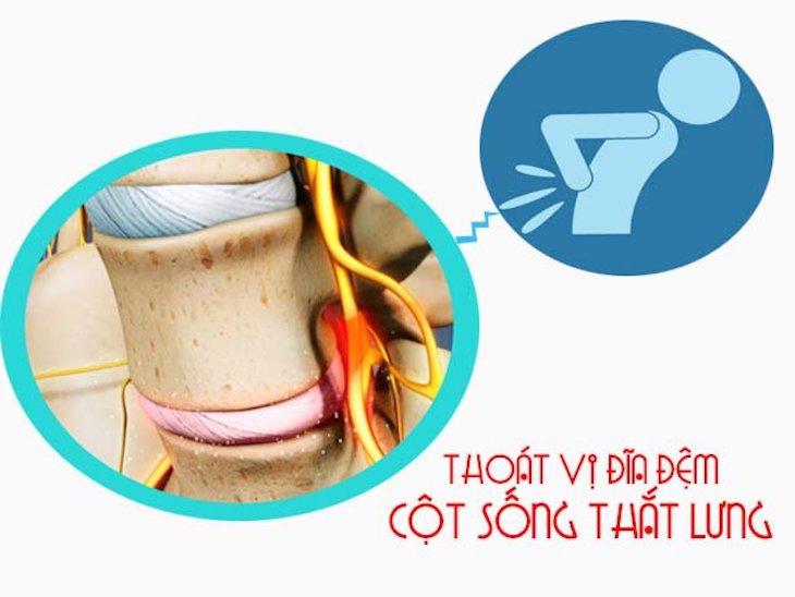 Thoát vị đĩa đệm cột sống thắt lưng - Nỗi khổ không của riêng ai