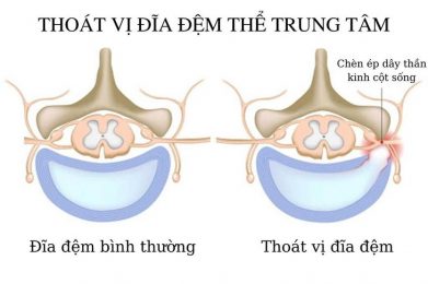 Chứng thoát vị đĩa đệm thể trung tâm khá phổ biến hiện nay