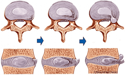 Hình ảnh thoát vị nội xốp