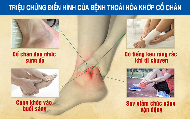 Những triệu chứng điển hình của thoái hóa khớp cổ chân