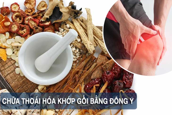 Chữa thoái hóa khớp gối bằng thuốc Đông y cho hiệu quả lâu dài