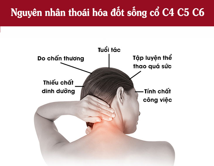 Một số nguyên nhân gây thoái hóa đốt sống cổ