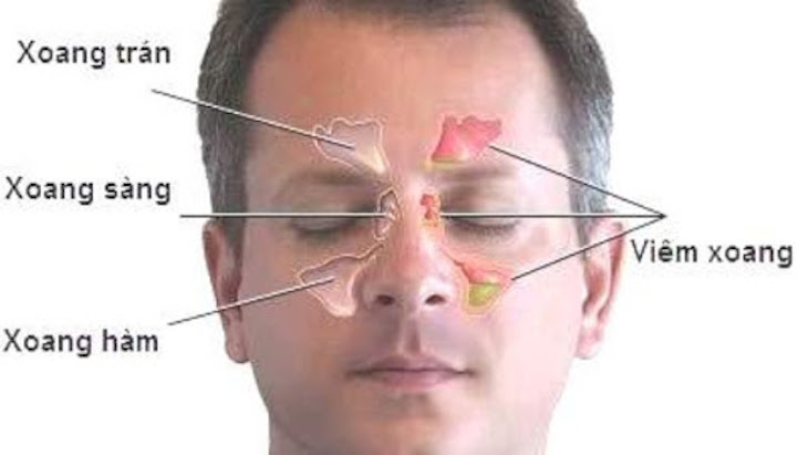 Phân loại bệnh viêm mũi xoang dựa theo vị trí