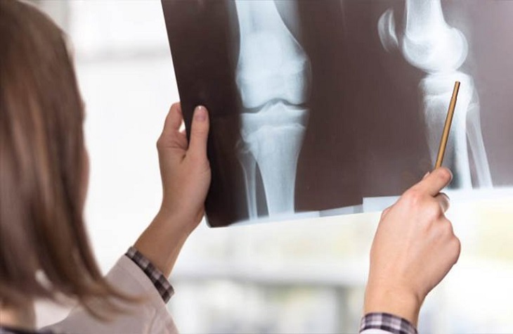 Chụp X - quang giúp chẩn đoán tình trạng thấp khớp