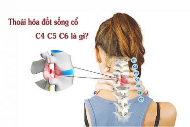 Hình ảnh thoái hóa của các đốt sống cổ C4 C5 C6