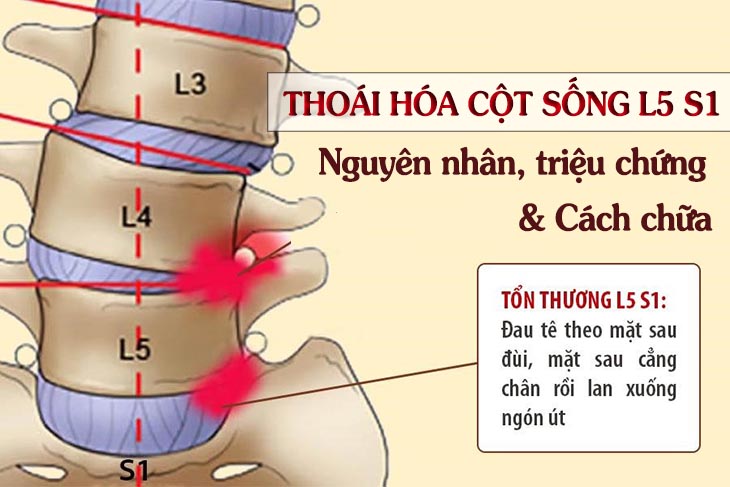 Thoái hóa đốt sống L5 S1 là bệnh lý mạn tính, tiến triển theo thời gian và tăng dần về mức độ