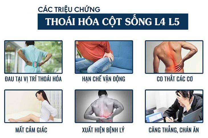 Các triệu chứng điển hình của thoái hóa cột sống 