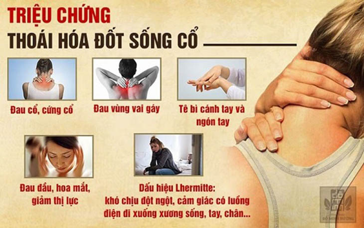 Các triệu chứng điển hình ở người thoái hóa đốt sống cổ C4 C5 C6