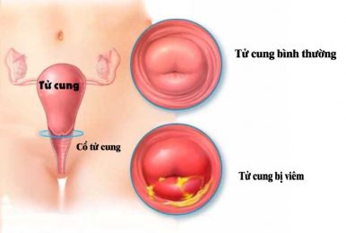 Viêm cổ tử cung là tình trạng các tế bào ở cổ tử cung bị tổn thương, viêm sưng, lở loét