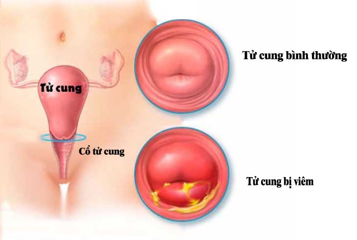 Viêm cổ tử cung là tình trạng các tế bào ở cổ tử cung bị tổn thương, viêm sưng, lở loét 