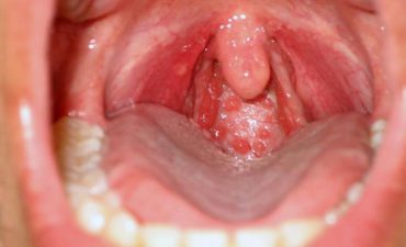 Hình ảnh viêm họng hạt