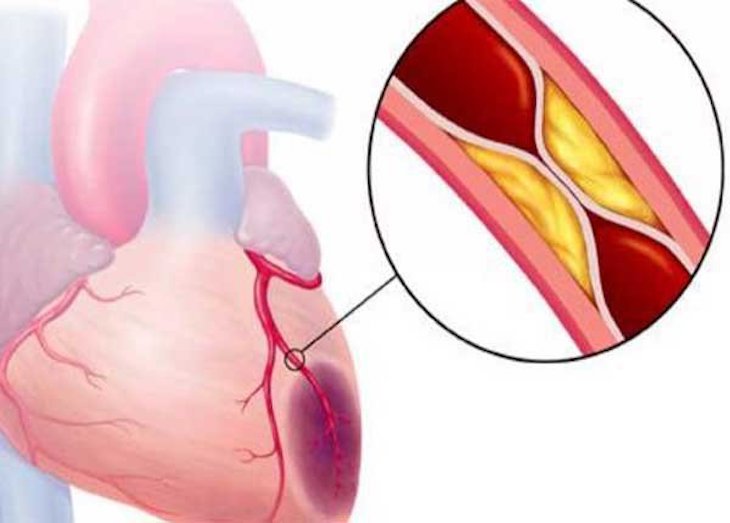 Cảm giác đau tức ngực có thể do bóc tách động mạch vành