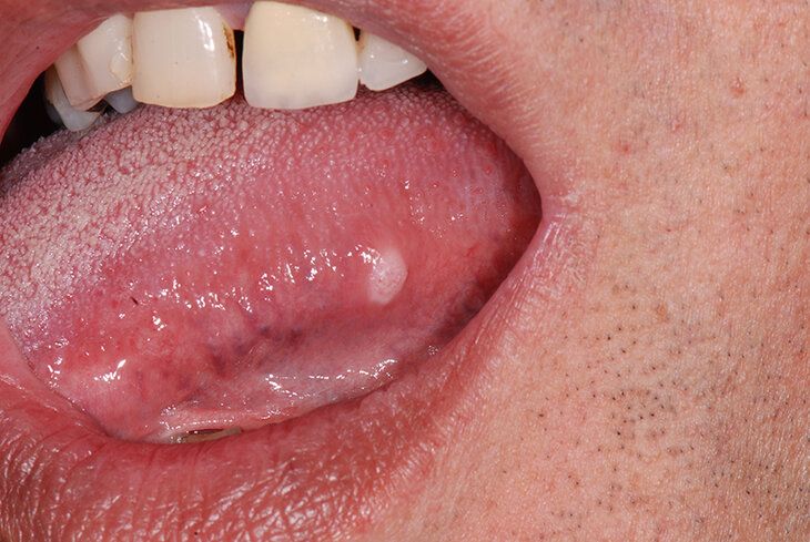 Đại đa số người bệnh gặp tình trạng này đều có nguy cơ mắc ung thư lưỡi giai đoạn đầu