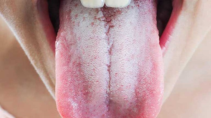 Lưỡi trắng đau họng là tình trạng xảy ra ở không ít người hiện nay