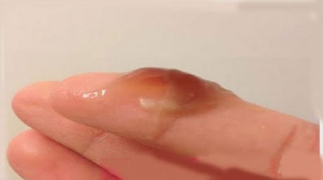 Có nhiều nguyên nhân khác nhau gây nên tình trạng ra máu màu nâu trước kỳ kinh nguyệt 10 ngày