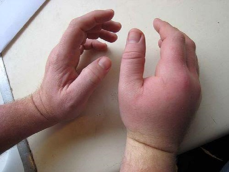 Hội chứng tiền sản giật cũng có thể khiến các mạch máu ở tay bị tắc nghẽn và sưng tấy