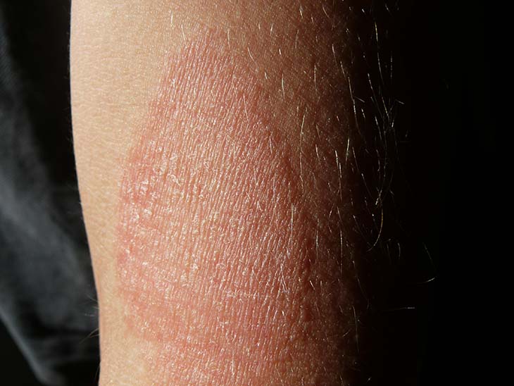 Bị bong da tay là biểu hiện của bệnh chàm và viêm da