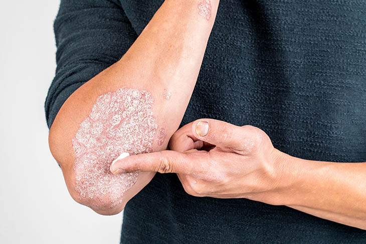 Bong da tay là biểu hiện của bệnh vảy nến