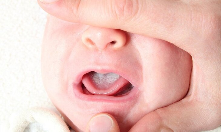 Các bệnh về lưỡi ở trẻ nhỏ đang là vấn đề được nhiều phụ huynh quan tâm