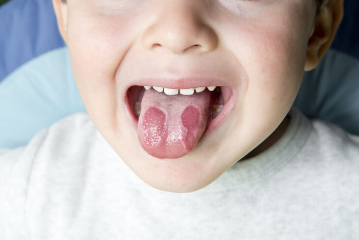 Viêm lưỡi bản đồ là một trong những bệnh về khoang miệng thường gặp ở trẻ em 