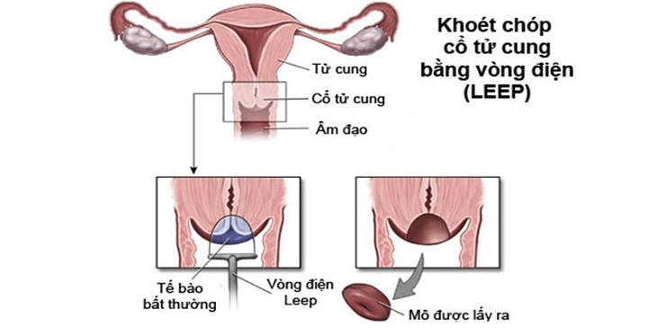 Điều trị viêm lộ tuyến cổ tử cung bằng dao leep mang đến hiệu quả nhanh chóng