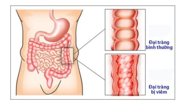 Viêm đại tràng có thể gây ra đau tức hạ sườn trái