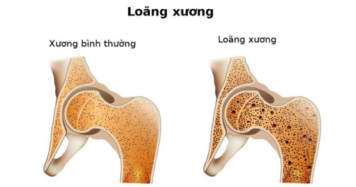 Đau tức hạ sườn trái có thể do loãng xương gây ra