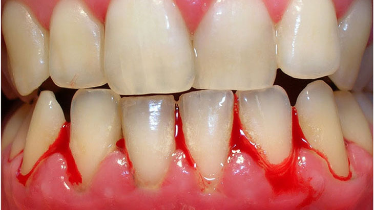 Chảy máu nướu răng cũng có thể làm nước bọt có lẫn máu