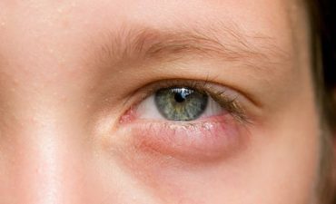 Trẻ bị sưng mí mắt dưới gây ra rất nhiều khó chịu cho bé