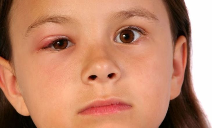 Chắp, lẹo thường gây sưng mí mắt dưới ở trẻ