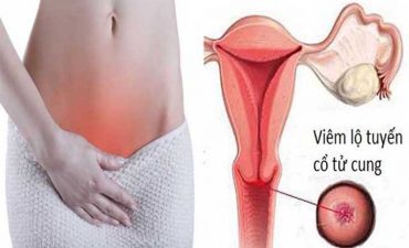 Thời gian điều trị viêm lộ tuyến cổ tử cung có lâu không