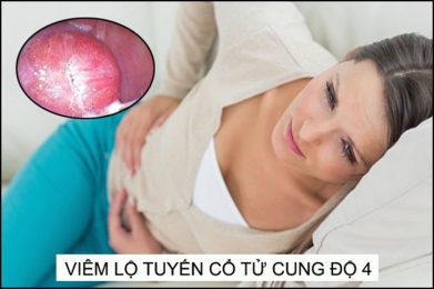 Viêm lộ tuyến cổ tử cung độ 4 có nguy hiểm không?