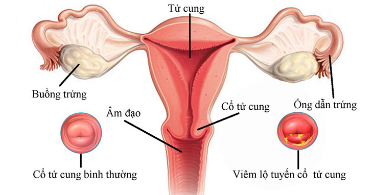 Viêm lộ tuyến độ 1 là giai đoạn nhẹ của bệnh