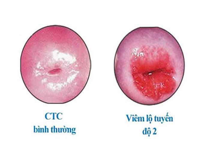 Viêm lộ tuyến độ 2 có nguy hiểm không và nó có triệu chứng như thế nào đang là câu hỏi của rất nhiều chị em.