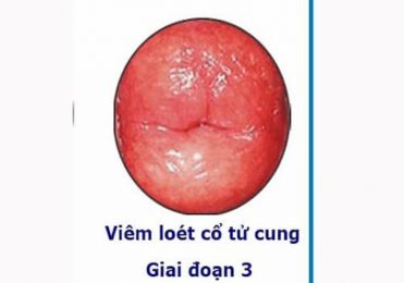 Viêm lộ tuyến độ 3 là giai đoạn nặng của bệnh