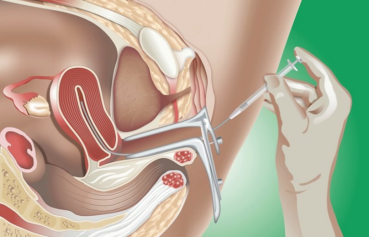 IUI là phương pháp thụ tinh nhân tạo phổ biến và cho hiệu quả tốt