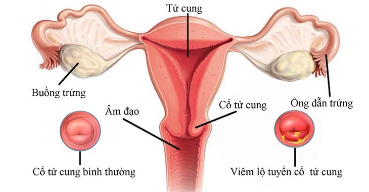 Nếu chị em bị viêm lộ tuyến khi mang thai thì cần lưu ý vì nguy cơ ảnh hưởng đến sức khỏe là rất lớn