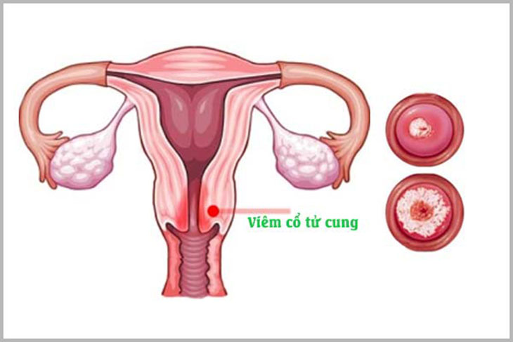 Điều trị viêm cổ tử cung khi mang thai